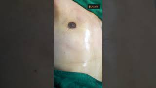 Gynecomastia Surgery | Gynecomastia Treatment