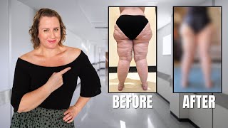 I Had Leg SURGERY (Lipedema - WAL Liposuction)
