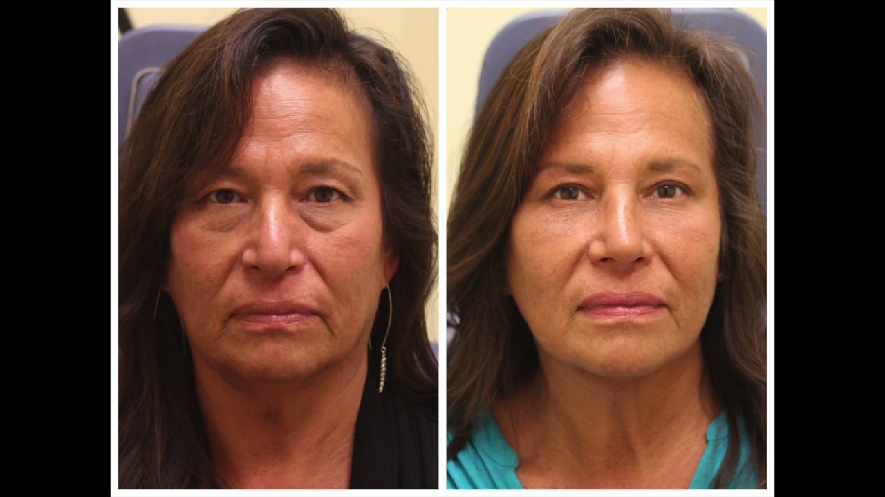 Before and after facial appearance comparison.
