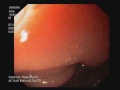 Download Video Endoscopy _ 1 02 Download Video Endoscopy _ 1 02