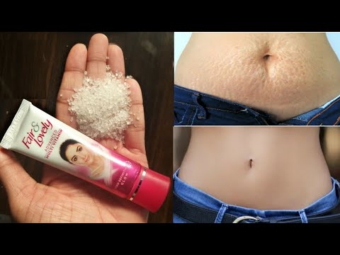 सिर्फ चंद मिनटों में STRETCH MARK पर इतना कमाल का असर करेगा की दुनिया आप से पूछने लगेगी