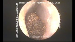 External ear canal cerumen removal with black hard lumps 20250811