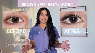 Brown Spot in Eye Gone!