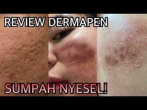 DERMAPEN REVIEW HARI KE HARI - GA NYANGKA JADI GINI