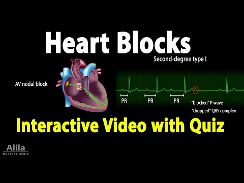 Heart (AV) Blocks - INTERACTIVE Animation with Quiz.