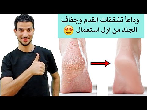 اقضي علي تشققات القدم والكوع وجفاف الجلد في 3 ايام
