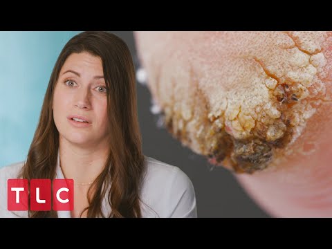 Patient's Foot Looks Like "Burnt Cauliflower" | My Feet Are Killing Me
