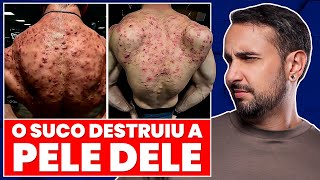 O PIOR CASO DE ACNE E ESTEROIDES QUE EU JÁ VI!