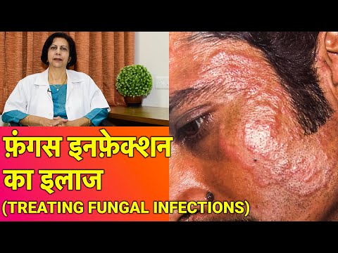 फ़ंगस इनफ़ेक्शन का इलाज || Fungal Infection Treatment