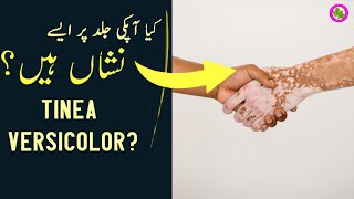 Phulwari Disease | Tinea Versicolor Skin Infection