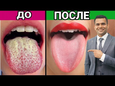 Лучший Способ Вылечить Кандидоз И Дрожжи