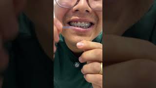 Así se limpia los brackets sigue estos pasos