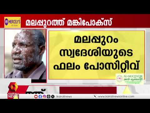 രോഗലക്ഷണങ്ങൾ പ്രകടമായതോടെ ചികിത്സ തേടുകയായിരുന്നു; മലപ്പുറം സ്വദേശിക്ക് എം പോക്സ് | monkeypox