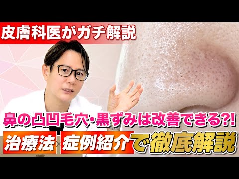 【2025年最新版】鼻の凸凹毛穴・黒ずみ改善！毛穴開きの原因を知ってエビデンスに基づいた正しい治療の選択を
