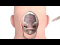 Craniectomy and Intracranial Pressure