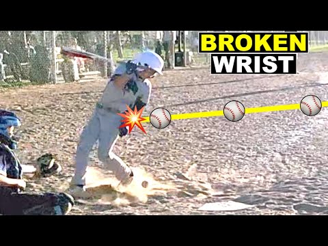 BROKEN WRIST FROM FAST BALL AT BASEBALL TOURNAMENT! ⚾️