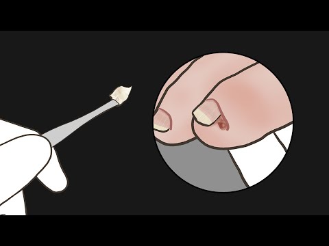 새끼발톱 속에 숨은 며느리발톱… 드디어 뽑았습니다! (자막으로 근황 토크 속닥속닥)