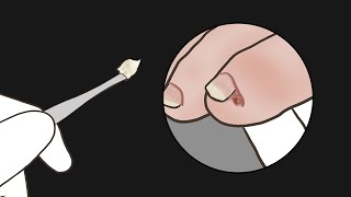 새끼발톱 속에 숨은 며느리발톱… 드디어 뽑았습니다! (자막으로 근황 토크 속닥속닥)