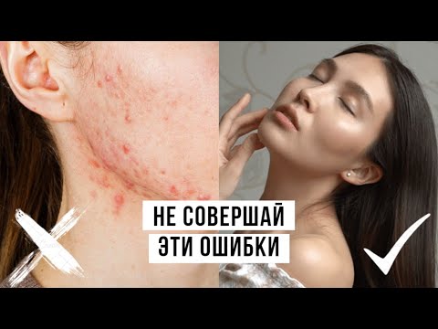 10 ошибок в уходе за кожей лица. Почему появляются прыщи?