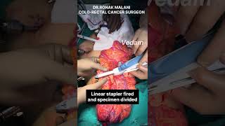 Laparoscopic right hemicolectomy #colorectalsurgery #vedamgastro #minimallyinvasivesurgery