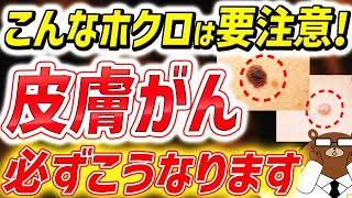 【猛暑の紫外線が危険】日本で激増している皮膚がんの超意外な初期症状とは。なる人の共通点は。体のこんな「ほくろ」は絶対見逃さないで！皮膚がんの「ABCDEサイン」とは。予防法は？医師が徹底解説！