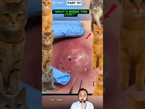 “You’ve Never Seen a Cyst Like This 😳 #shortsfeed #Shorts