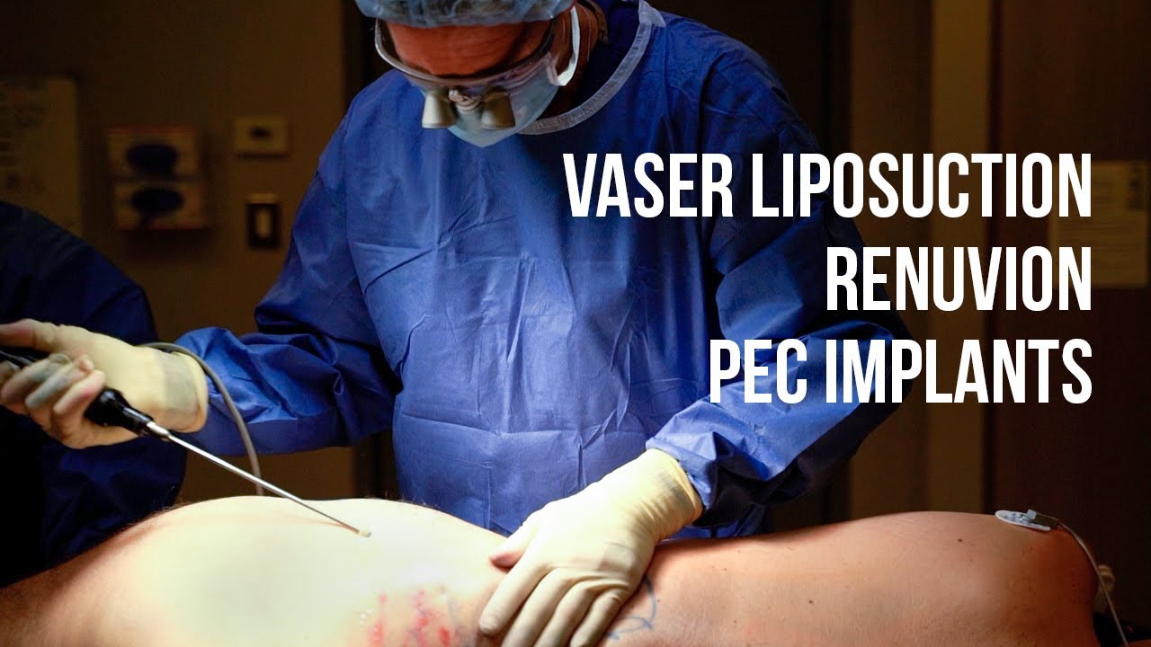 Surgeon performing VASER liposuction procedure.