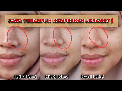 TERCEPAT❗️7 HARI MENGGUNAKAN SKINTIFIC INTENSIVE ACNE SPOT UNTUK MENGHIKANGKAN JERAWAT