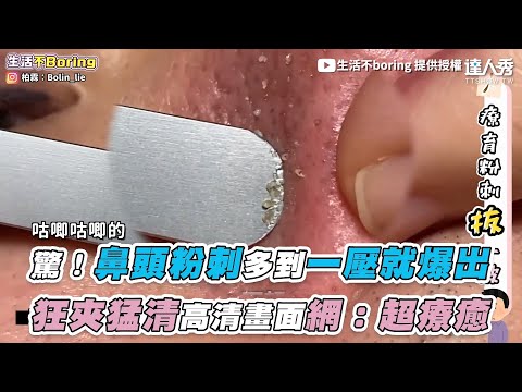 【驚！鼻頭粉刺多到一壓就爆出 狂夾猛清高清畫面網：超療癒】｜@生活不boring