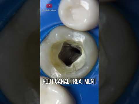 Endodoncia o Tratamiento de Conductos en 4K