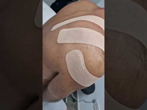 Shoulder taping with our i-Strips