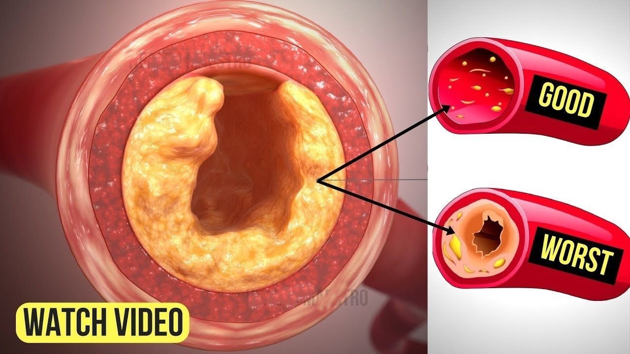 8 Foods That Can Clear Bad Cholesterol From Your Arteries