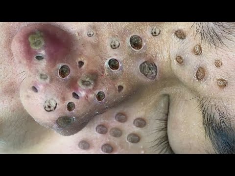 Blackhead Removal With Sac Dep Spa @100074544