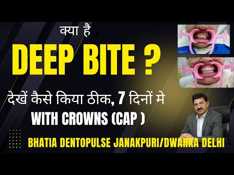 DEEP BITE क्या है ,देखें कैसे किया ठीक, 7 दिनों मे with Crowns (CAP )