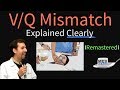 Understanding VQ Mismatch and Hypoxemia