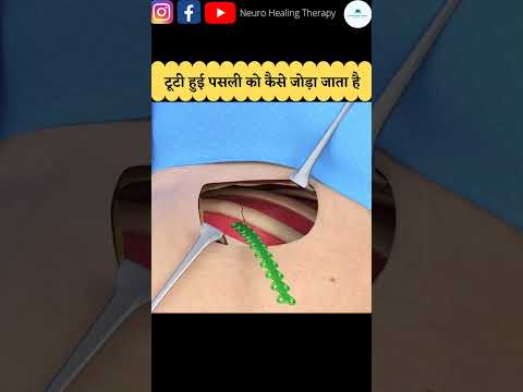 पसलियाँ टूटने पर कैसे जोड़ा जाता है #shorts #health