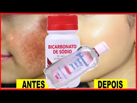 Como TIREI MANCHAS em poucos  DIAS Adeus MELASMA ESPINHAS AXILAS VIRILHA MANCHAS DE TODO TIPO