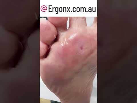 Painful forefoot callus temoval by podiatrist in clinic
