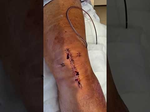 MI RODILLAS 12 HORAS DESPUÉS DE LA OPERACIÓN | Valentí Sanjuan #shorts