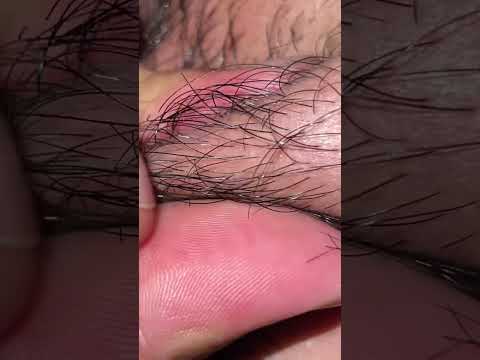 #satisfying #asmr #thebarbersarms #pimple #beard #<strong>live</strong> #<strong>extraction</strong> #ihavethisthingwithplants #viral
