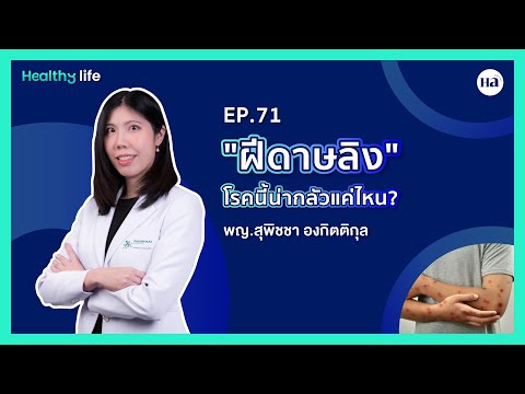 HealthyLifeEP.71:“ฝีดาษลิง”โรคนี้น่ากลัวแค่ไหน🐒