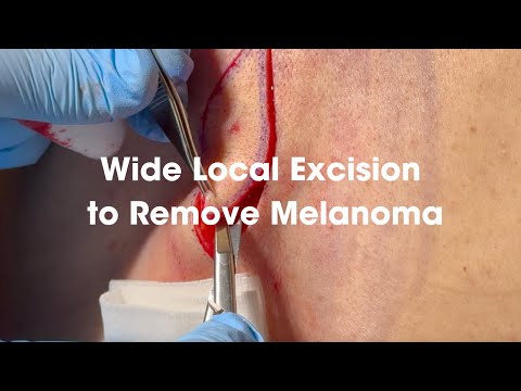 Wide Local Excision to Remove Melanoma