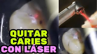 Quitando Caries dental con Láser