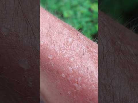 🔥 Sunburn Disaster! -- Blistering Skin After Days on the Road