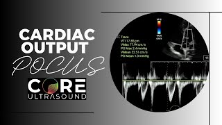 Measuring Cardiac Output Using Point-of-Care Ultrasound