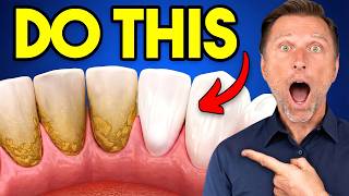 The #1 BEST Remedy for Dental Plaque (TARTAR)