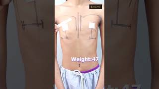 300cc Breast Implant Marking before surgery
