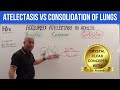 Lung Consolidation and Atelectasis Concepts