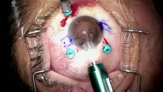 Removal of dislocated Lens/Bag complex+CTR, PPV and Yamane by Steven G. Safran MD