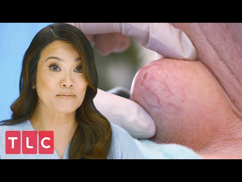 Squeezing a Throbbing Neck Cyst | Dr. Pimple Popper